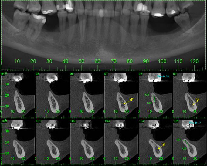 Figura 1: Rx panorâmica e cortes tomográficos mostrando o defeito ósseo na região de mandíbula esquerda posterior, e a cercania ao nervo dentário inferior.