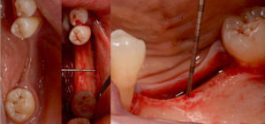 Figura 2. A) vista oclusal da área recetora; B) Vista oclusal do descolamento do tecido da área recetora; C) vista lateral do defeito.