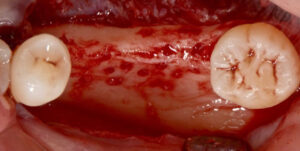 Figura 5. Vista oclusal e vestibular da área do defeito ósseo com perfurações para melhorar a irrigação e nutrição do enxerto.